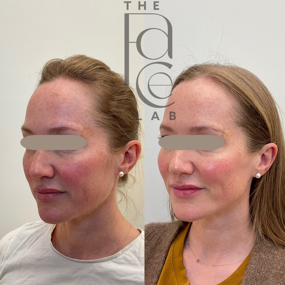 Before and after Baby Glow Redensity 1 injectable skin booster treatment in Toronto at The Face Lab showing collagen support, glowing skin, reduced crepey texture, improved luminosity, and refreshed natural-looking facial rejuvenation.