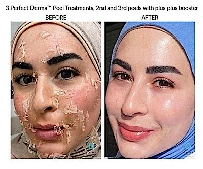 Perfect Derma Peel Result 3