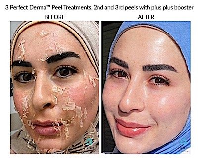 Perfect Derma Peel treatment result