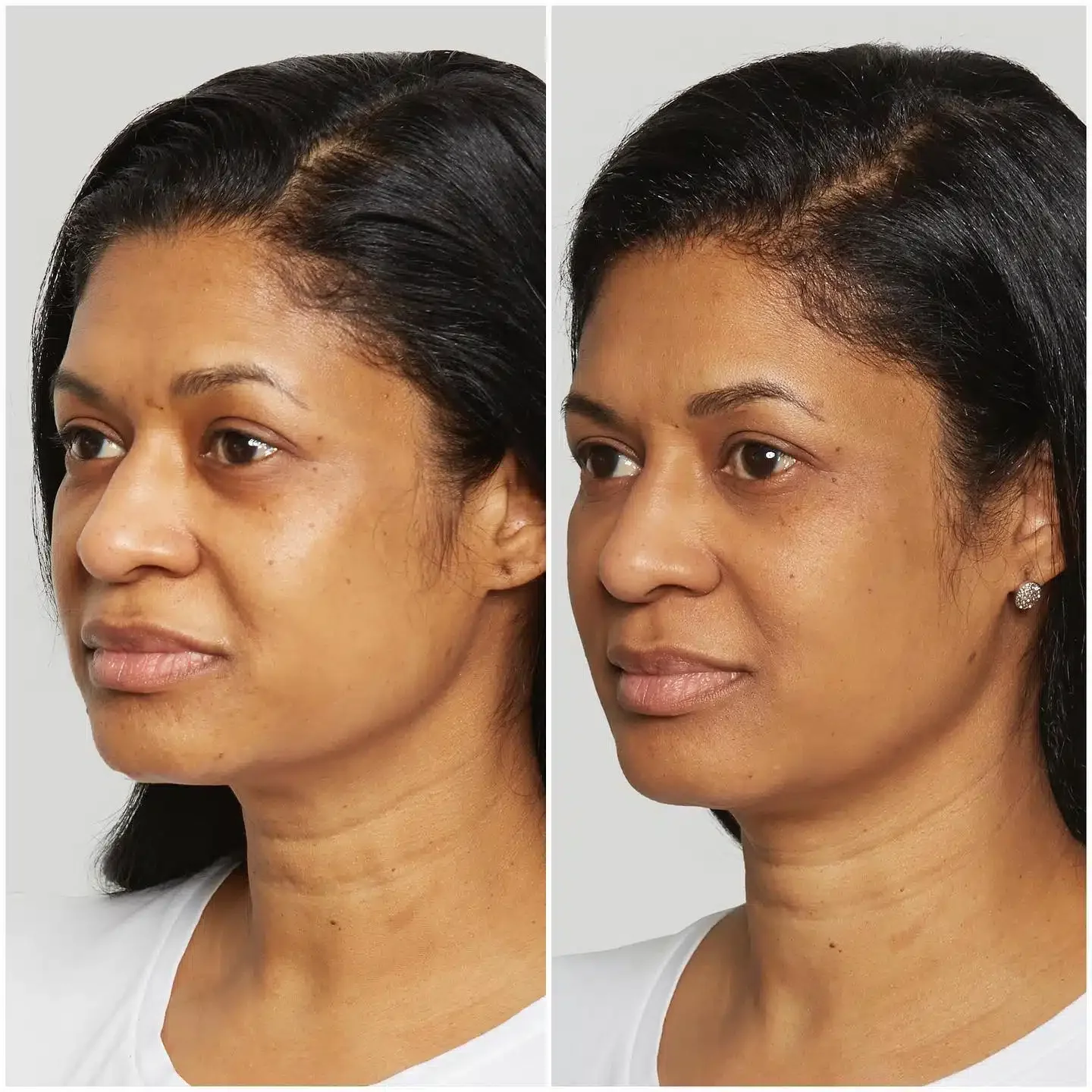 Sculptra treatment vial