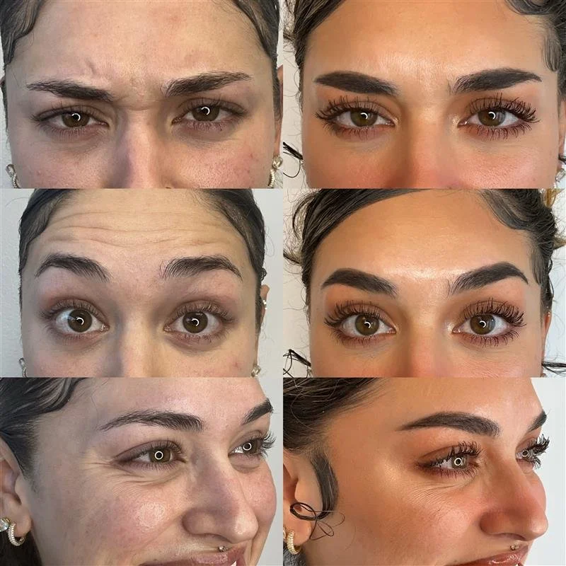 Botox before and after results
