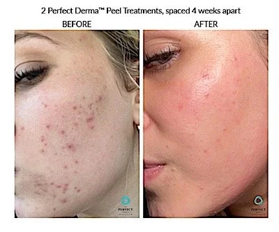 Perfect Derma Peel skin result