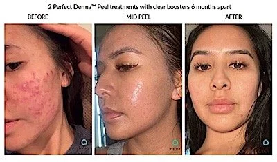 Perfect Derma Peel before and after result