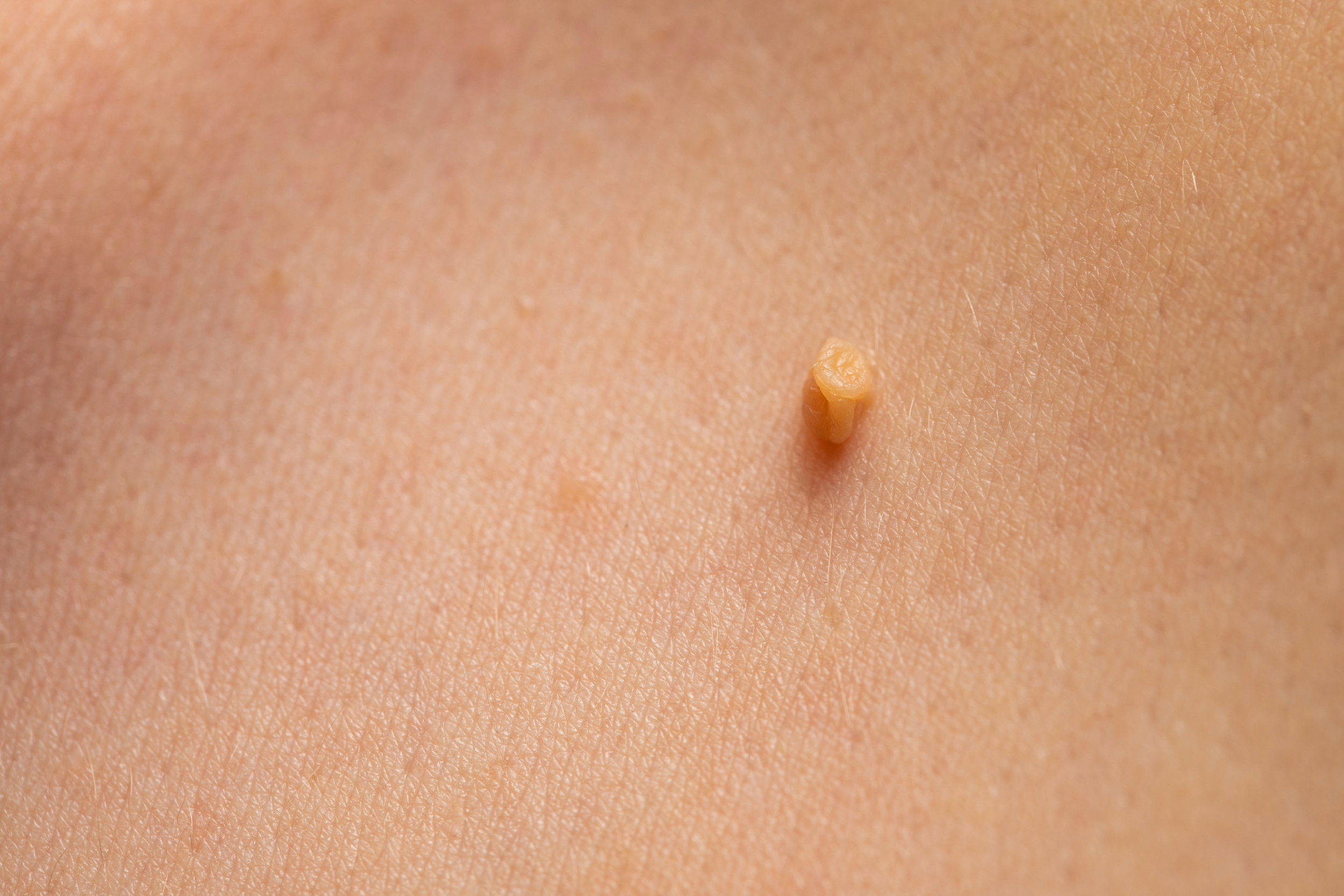 eliminacion verrugas genitales