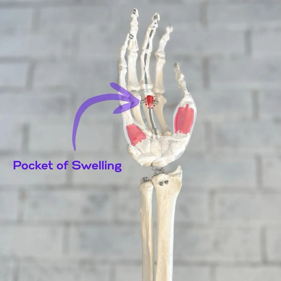 It could be a &ldquo;Trigger Finger&rdquo;. A trigger finger is when there is an &ldquo;impingement&rdquo; aka pouch of swelling on the flexor tendon not allowing a smooth glide to close your hand. Hand therapy can help #handphysio #handpain #locking