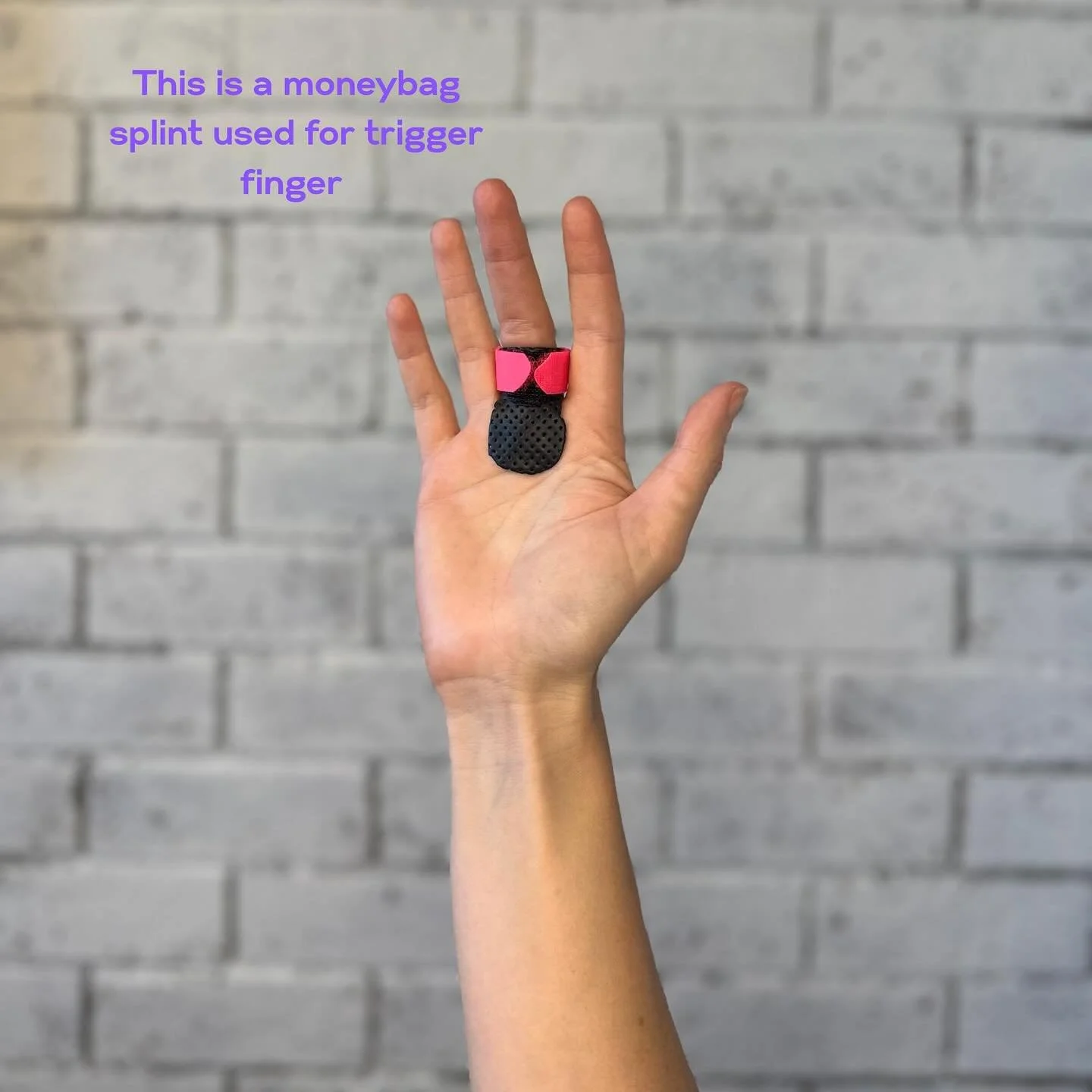 This is a custom thermoplastic splint called a &ldquo;Moneybag&rdquo; splint. It will stop the movement before the finger catches or locks. Our virtual clinic can help! #handphysio #handpain #lockingfinger