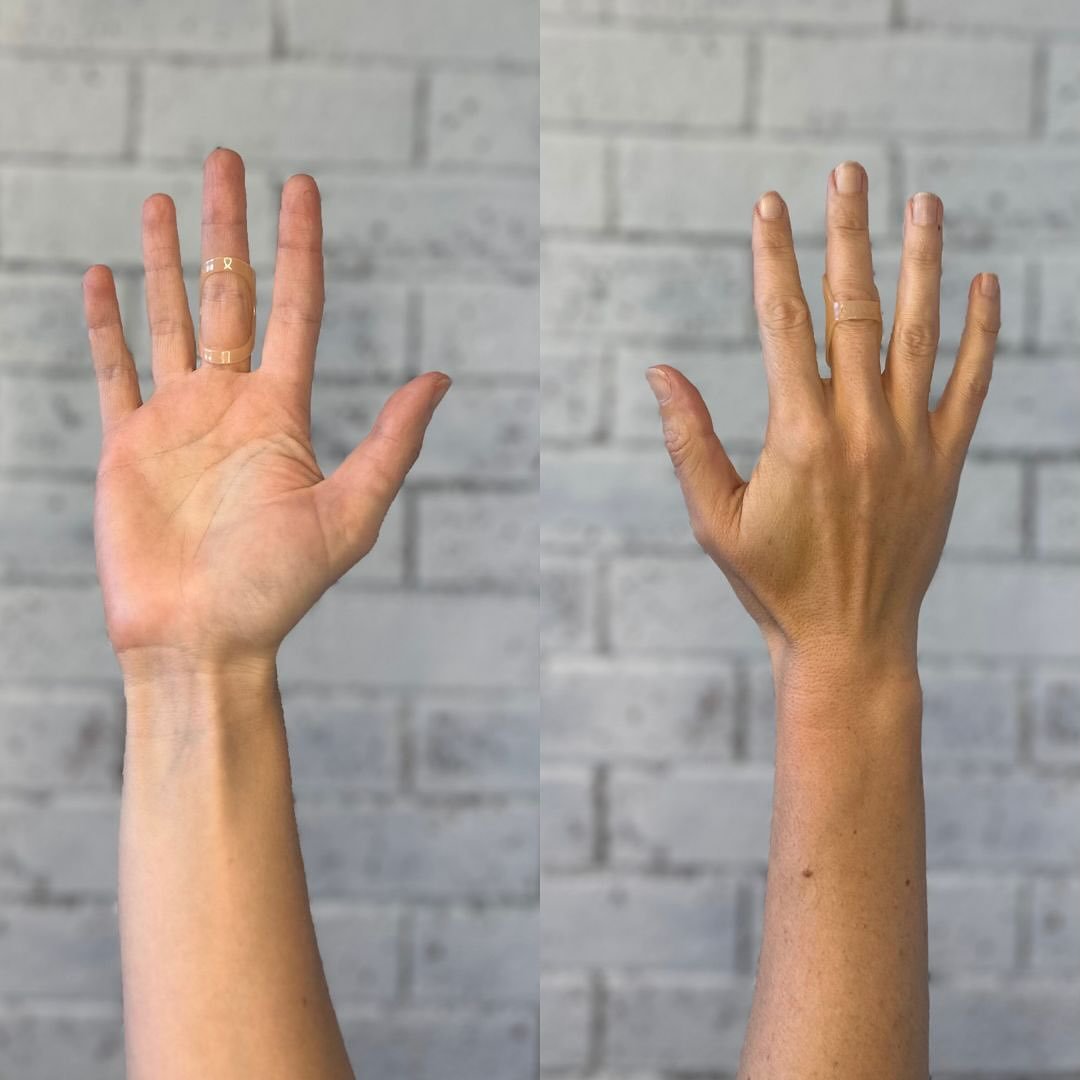 Another option for trigger finger is an off the shelf oval 8 splint. This splint limits movement at the next joint which some people find more comfortable. Contact us for a consultation: admin@regionalacutecare.com #handphysio #handpain #lockingfinge