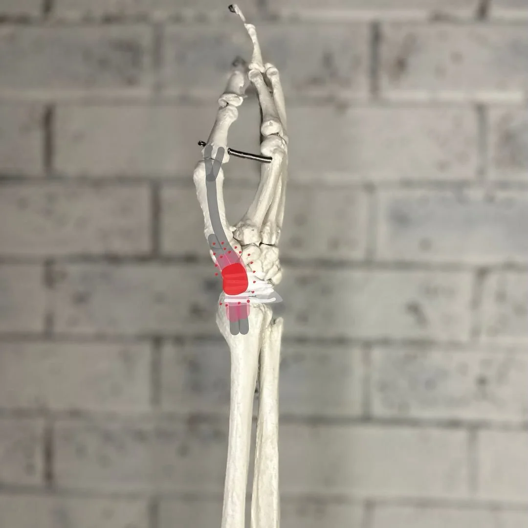 The pain you could be having is called DeQuervains tenosynovitis. This is when inflammation occurs around two thumb tendons as they travel past the wrist. Hand therapy can help. Book an appointment with us #handphysio #wristpain #thumbpain