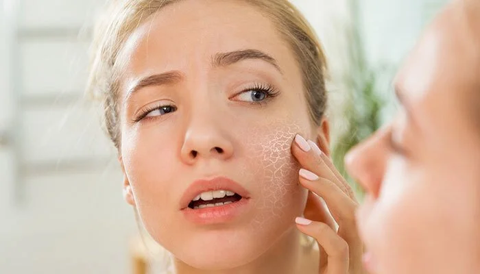 Close-up of a woman with dry, flaky skin on her cheek, touching her face with a concerned expression.