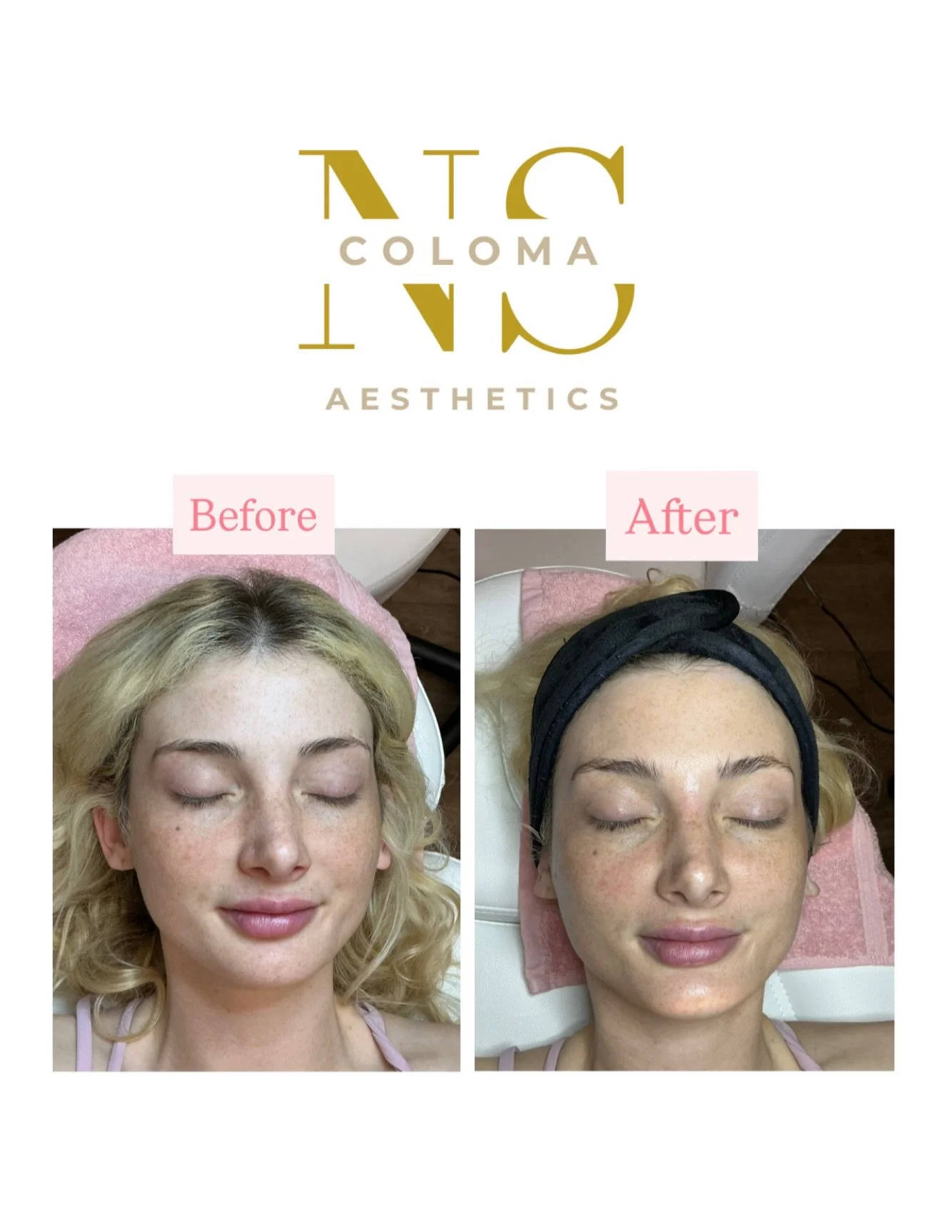 ✨ Before &amp; After Deluxe HydraFacial ✨
Our gorgeous client came in for some self-care and left with an instant glow. After just one Deluxe HydraFacial, her skin is deeply hydrated, refreshed, and radiant from the inside out. 

➡️ Swipe to see the 