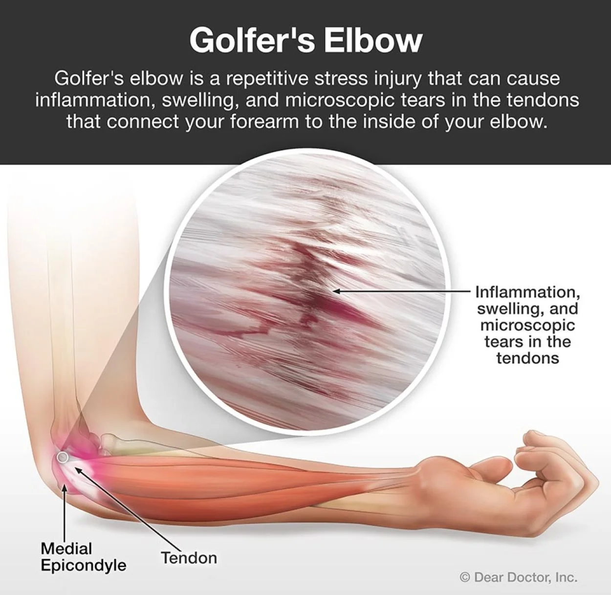 Diagram about golfer's elbow aka medial epicondylitis