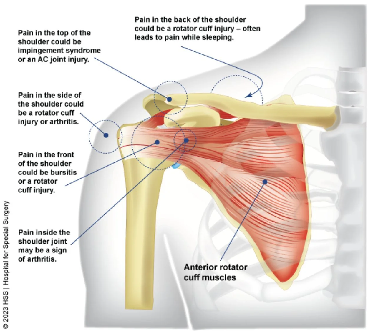 An infographic about location of shoulder pain and possible diagnoses