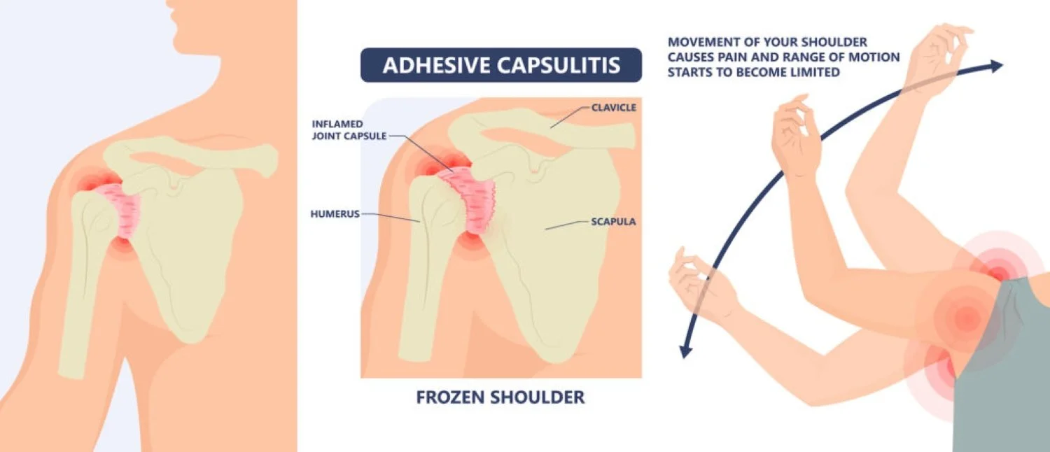Diagram about adhesive capsulitis causing pain and restrictions