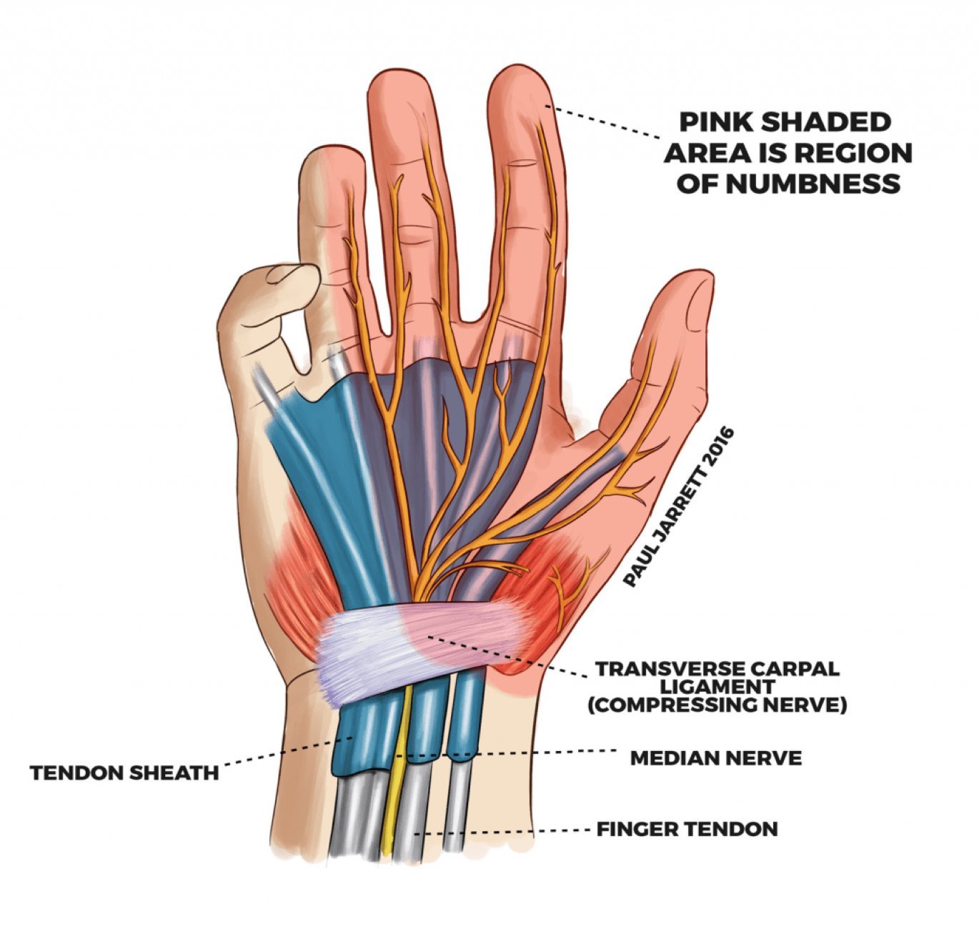 Graphic of the palmar side of a hand's anatomy, causes, and symptom area of carpal tunnel syndrome (CTS)