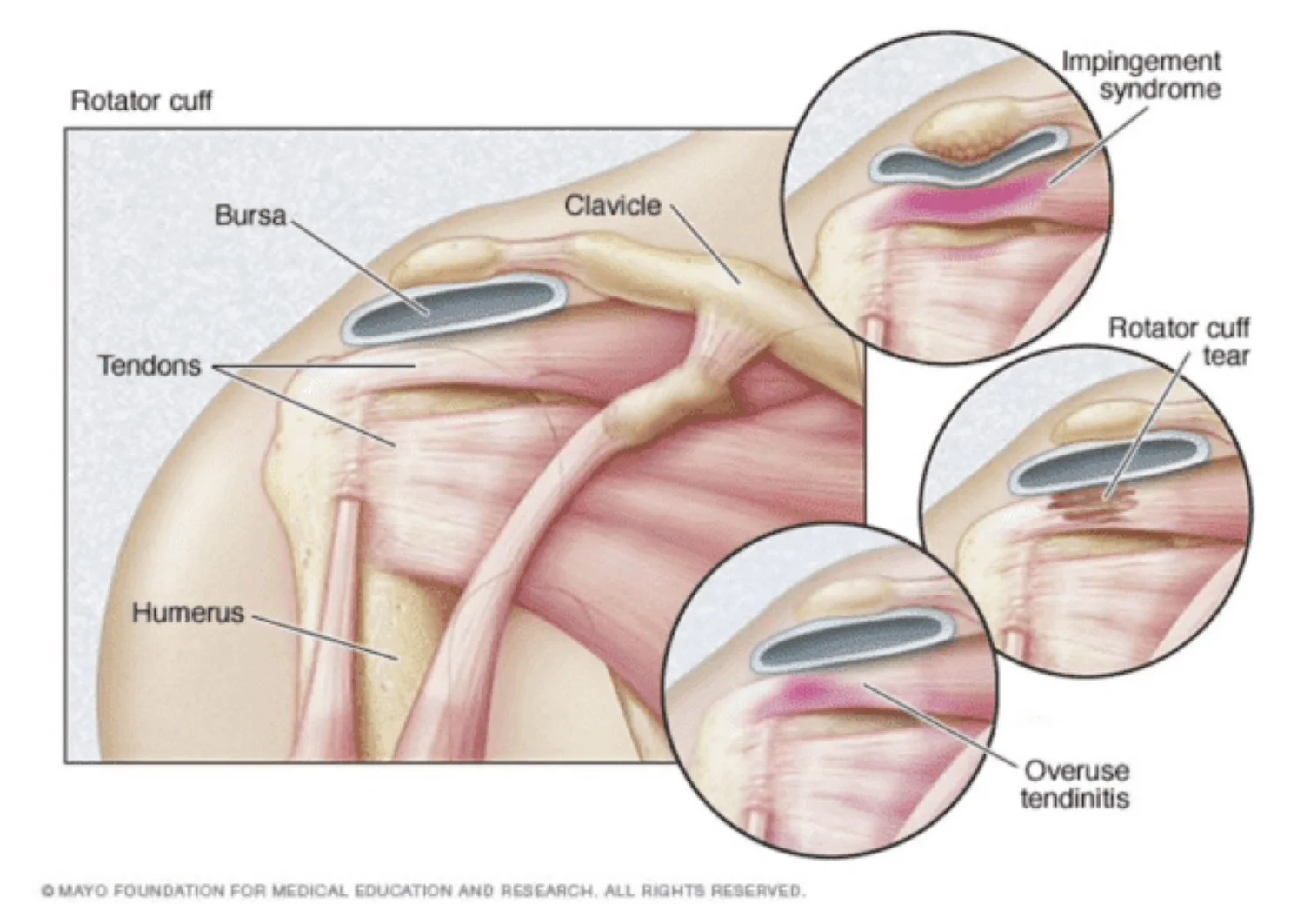 A diagram of the shoulder anatomy and common injuries, such as subacromial impingement