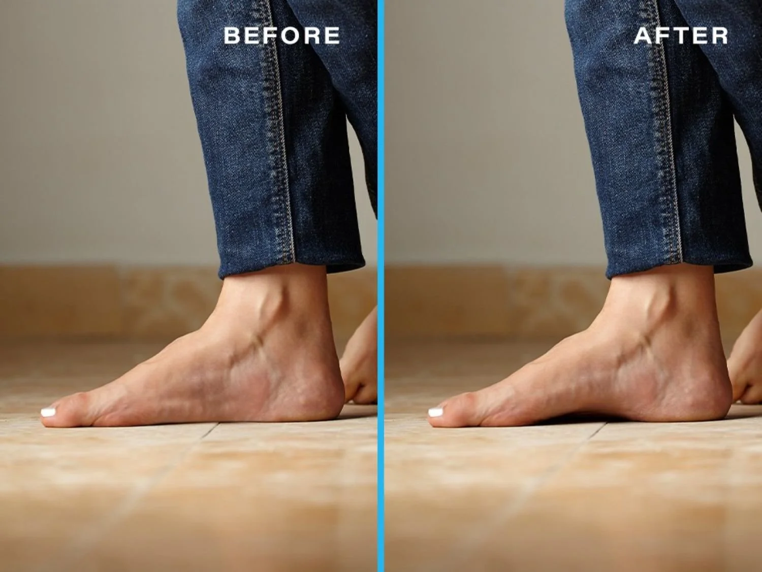 PT: The Long-Term Solution for Flat Feet (Pes Planus)
