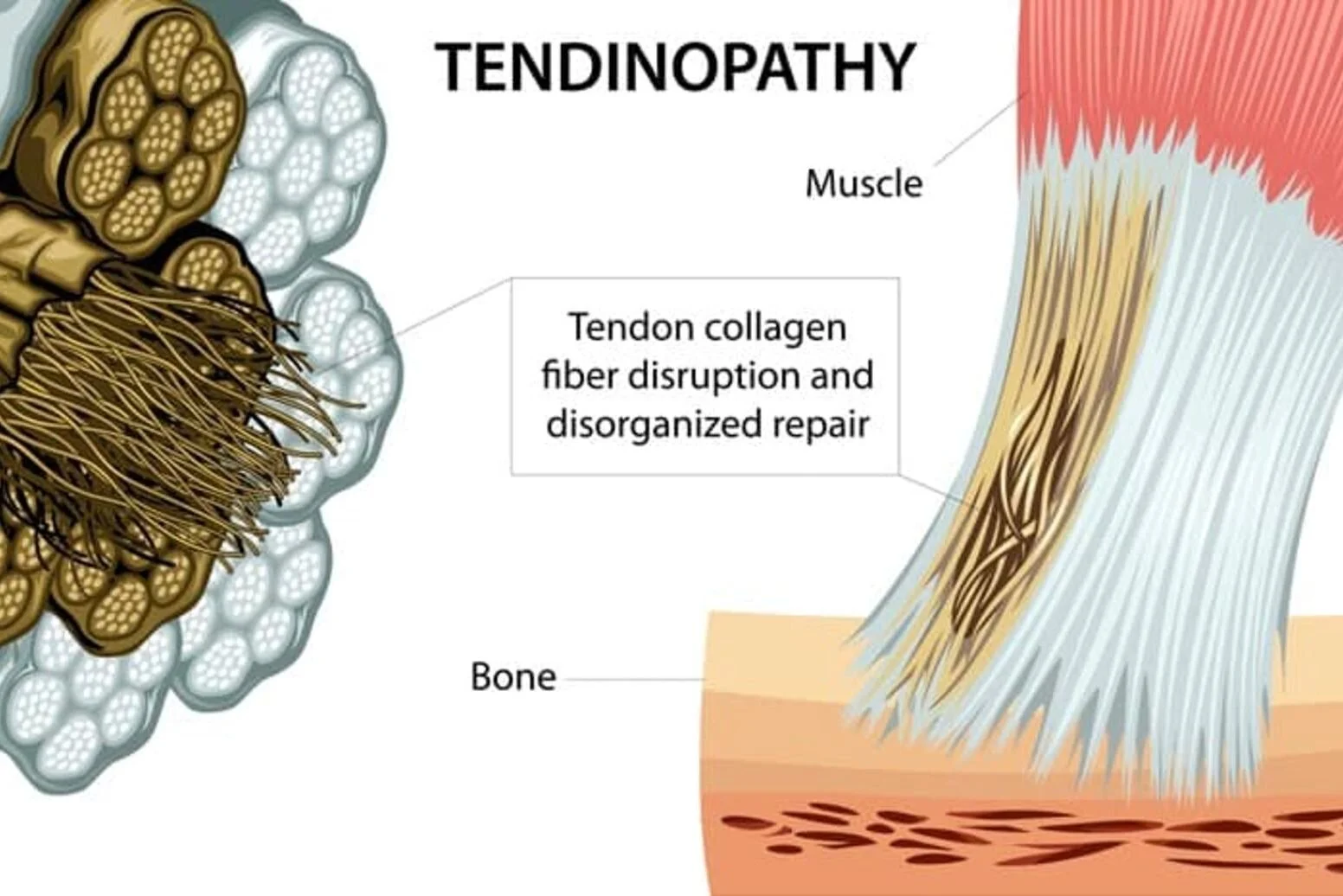Why Tendon Pain Becomes “Stubborn” and Why Rest Alone Fails