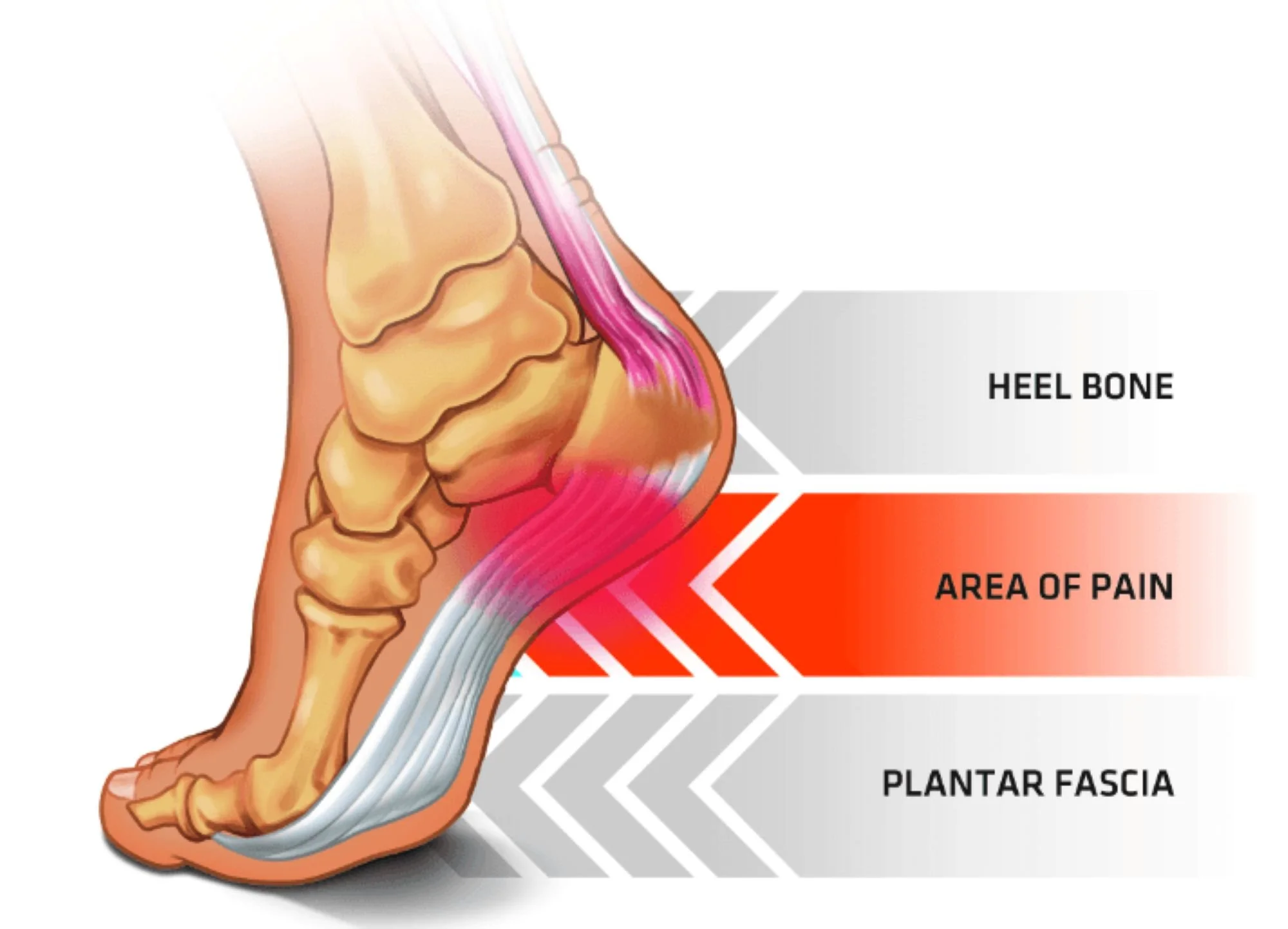 Why Stretching Doesn't Fix Heel Pain and What Actually Works