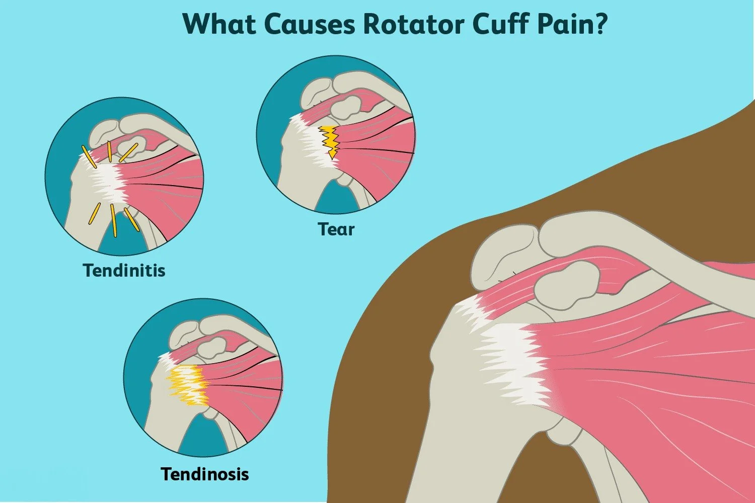 Diagram of various causes or diagnoses can cause rotator cuff pain