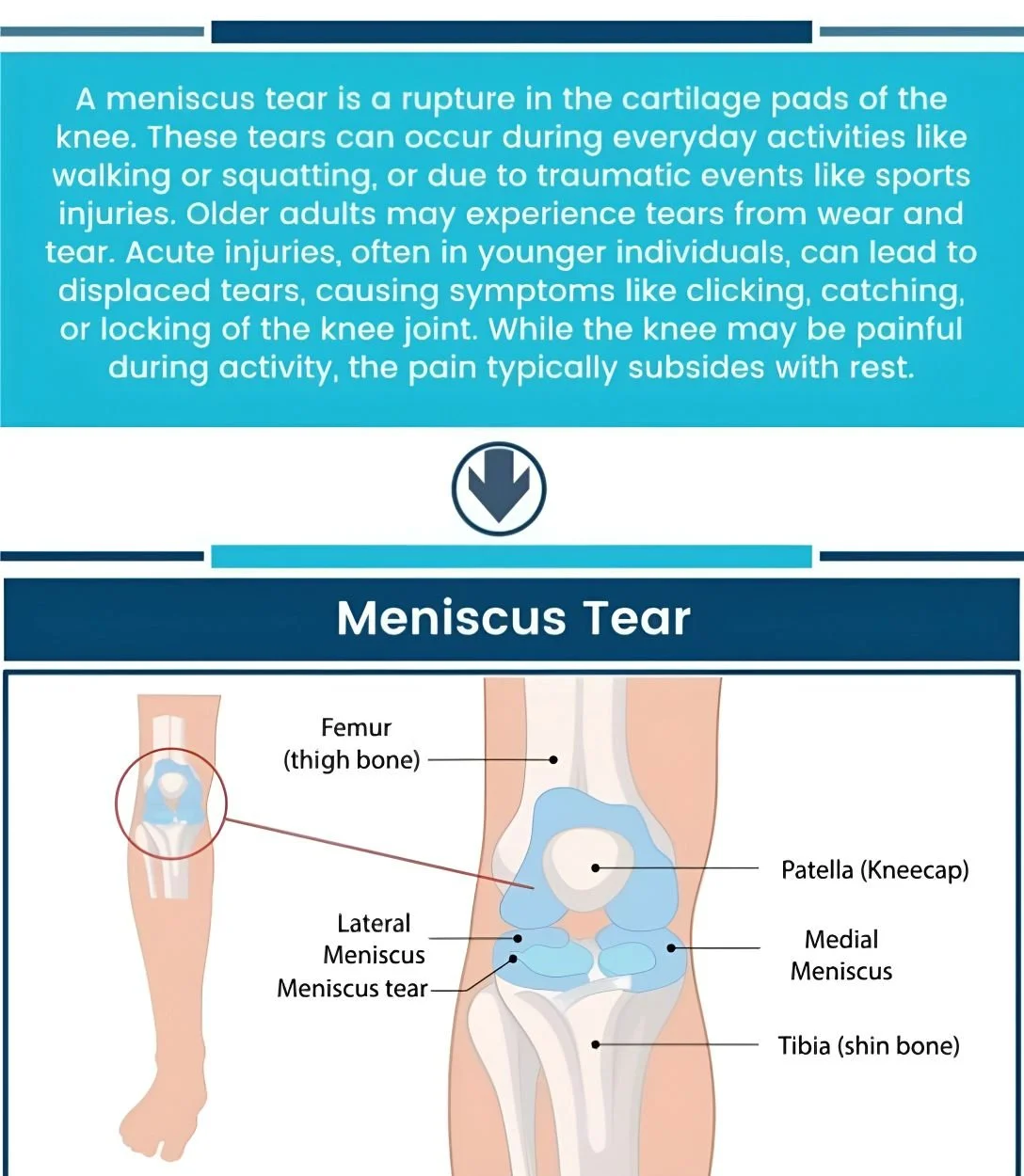 An infographic about what a meniscus tear is, common causes, and symptoms.