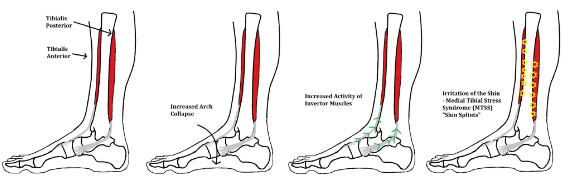 Infographic demonstrating some common causes of shin splints
