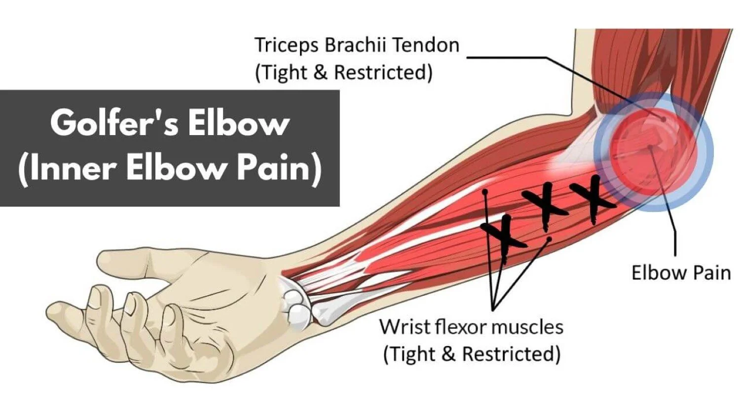 An infographic about inner elbow pain, or golfer's elbow pain