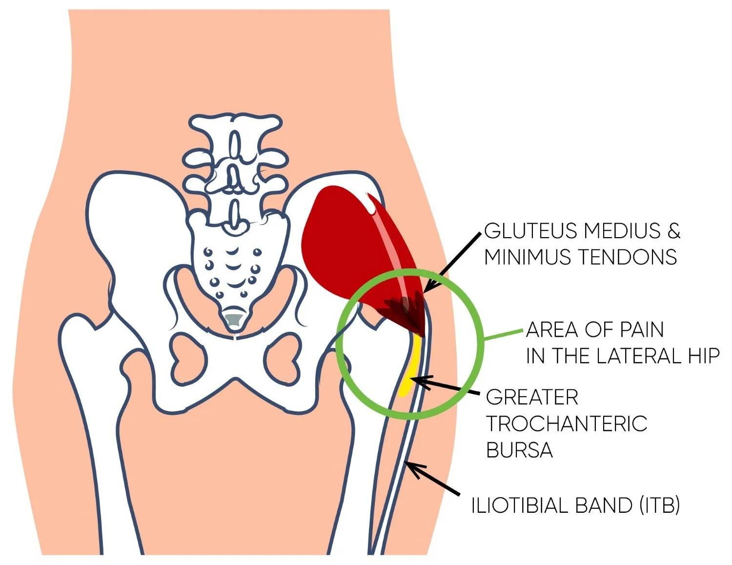 A diagram of a person's lumbopelvic and hip anatomy related to greater trochanteric pain syndrome