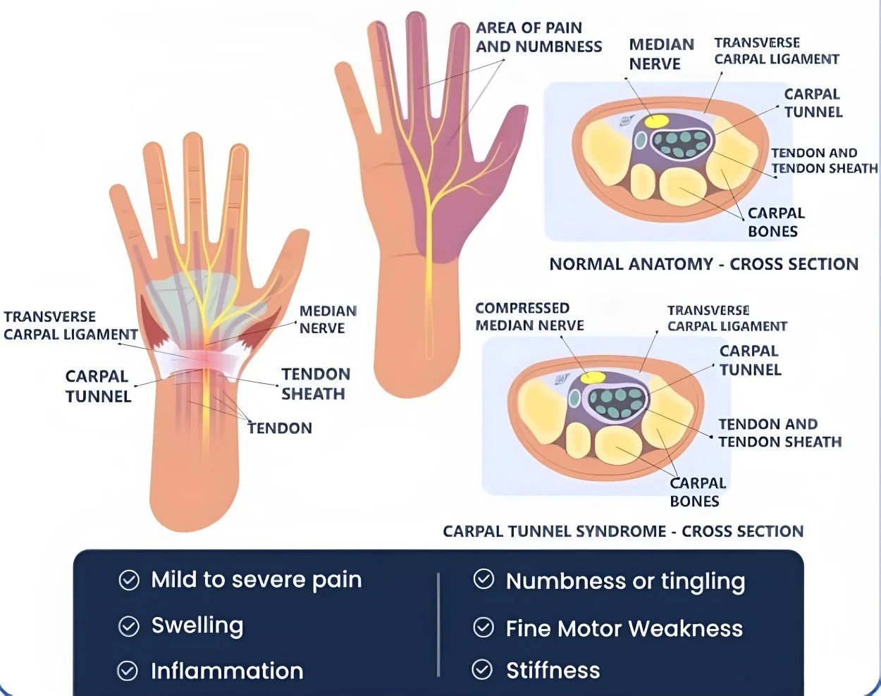 Infographic about carpal tunnel syndrome (CTS) and its symptoms.