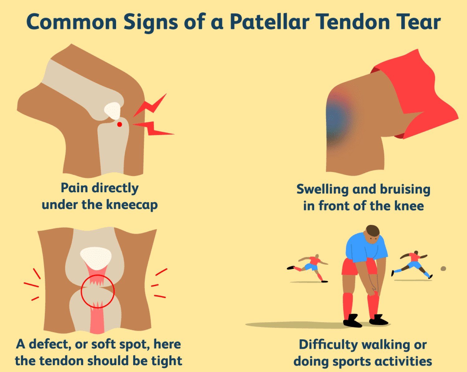 Infographic about common signs of a patellar tendon tear.