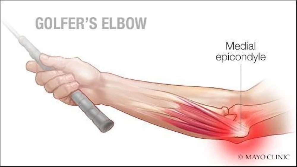 A figure demonstrating the anatomy of medial epicondylitis and how it is caused by overuse