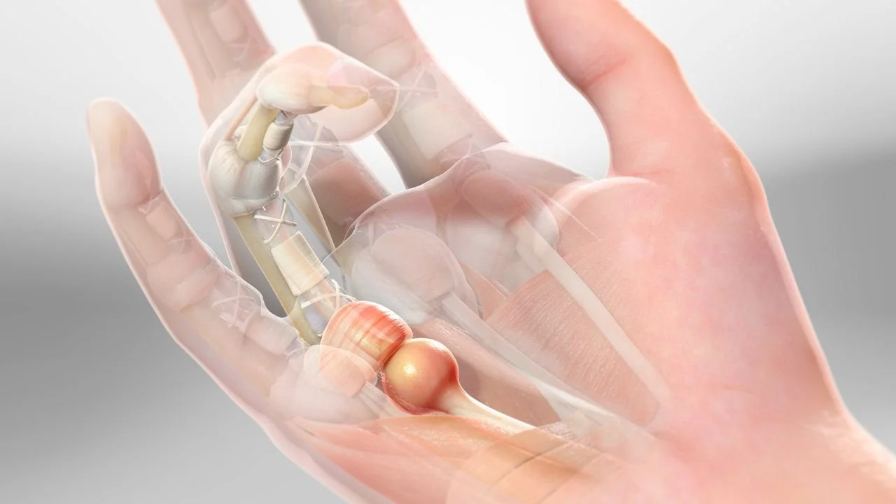 Detailed picture of a person's hand with overlaid anatomy of the tendons and pulleys  demonstrating trigger finger