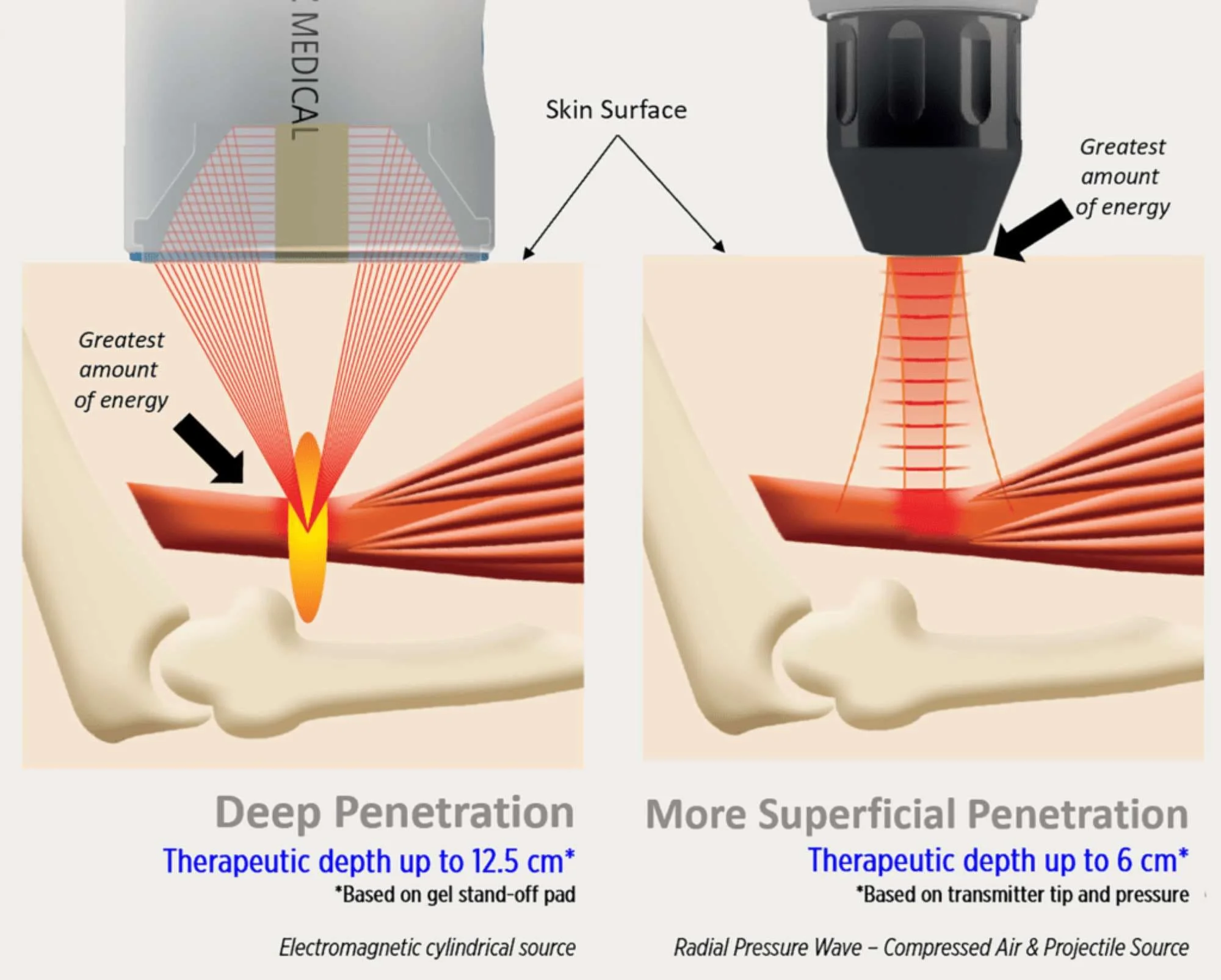 Infographic about focused shockwaves and radial pressure wave to treat medial epicondylitis inner elbow pain