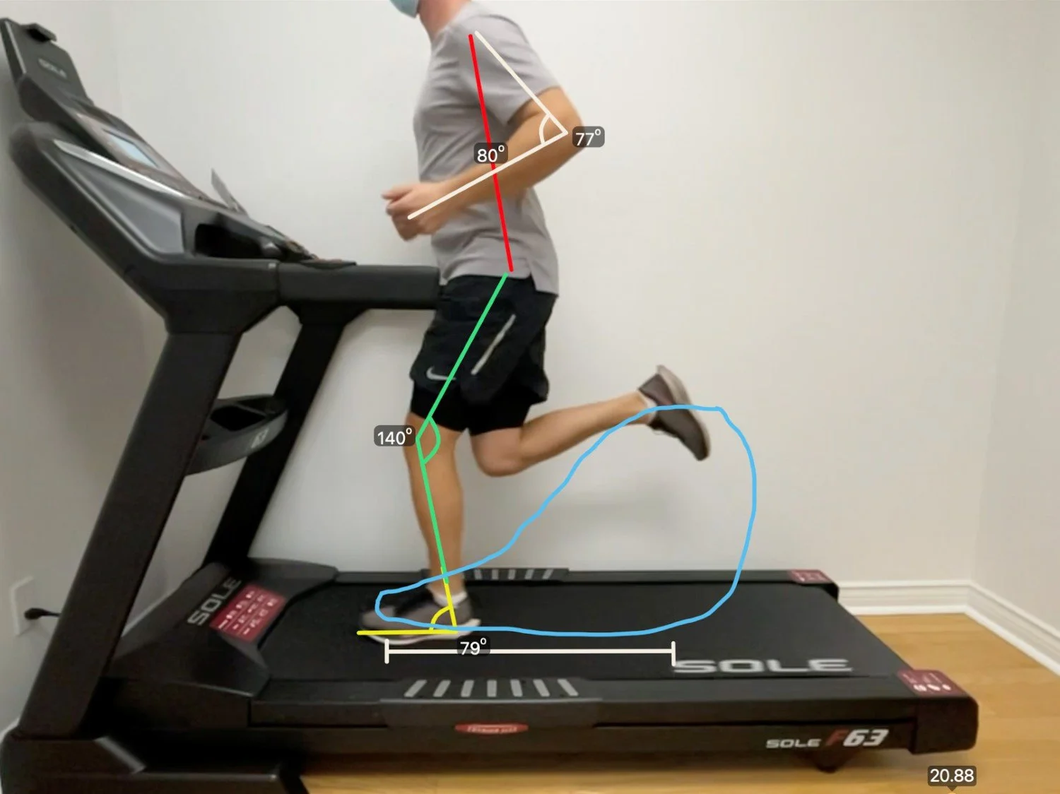 A patient runs on the treadmill during a physical therapy gait assessment in hillsboro, OR