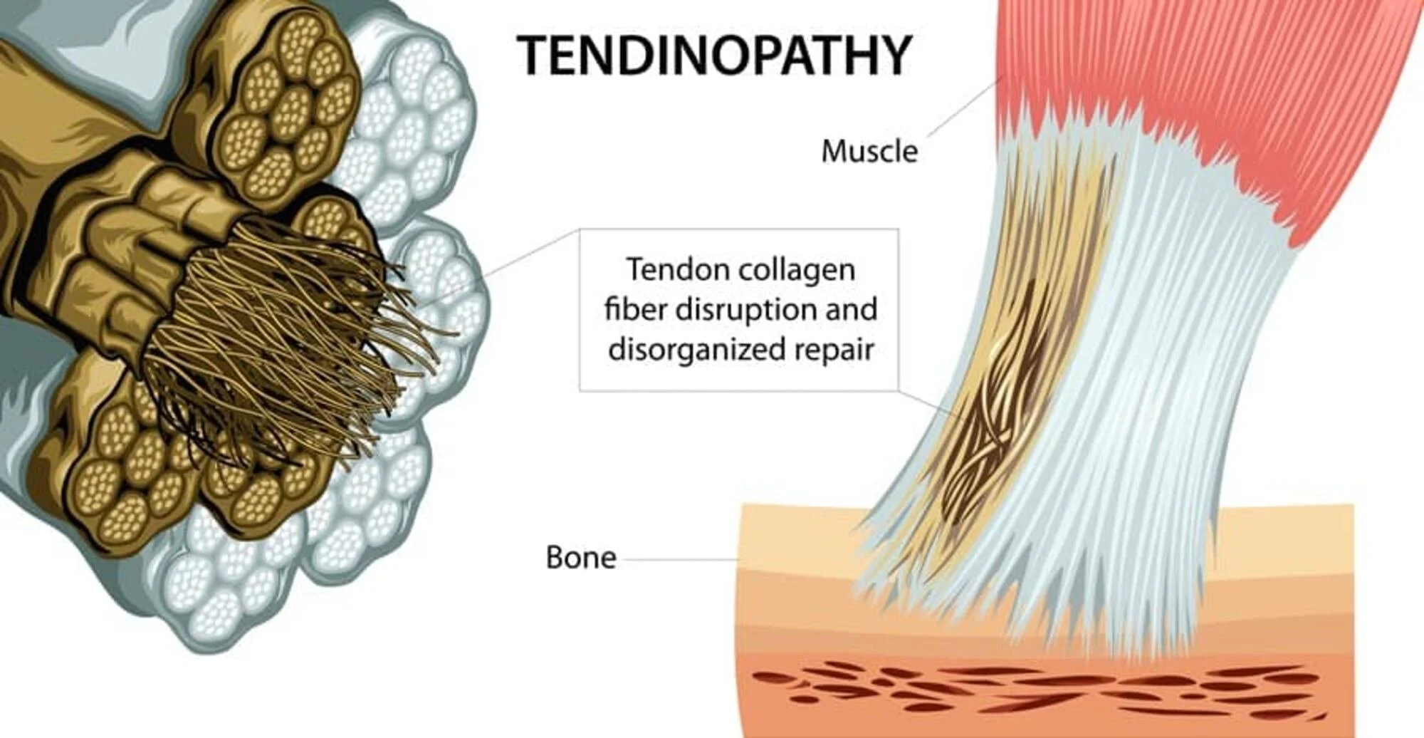 An image of tendinopathy down at the microscopic level
