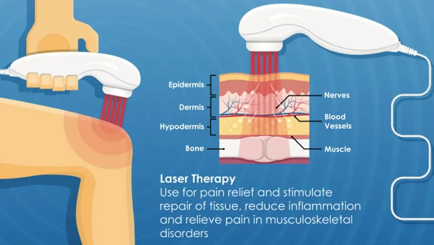 An infographic about laser therapy and its uses for musculoskeletal disorders