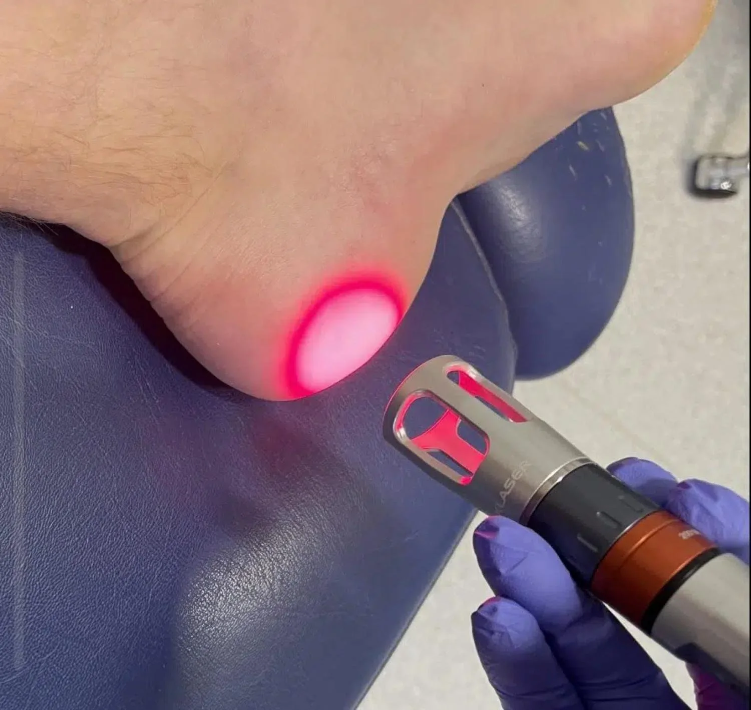 Image of class 4 laser therapy device being used to treat heel pain