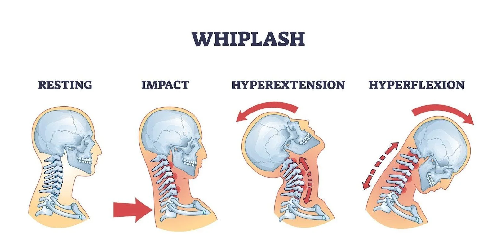 An infographic demonstrating how one gets whiplash during a car crash using images of the anatomy of the head and neck.