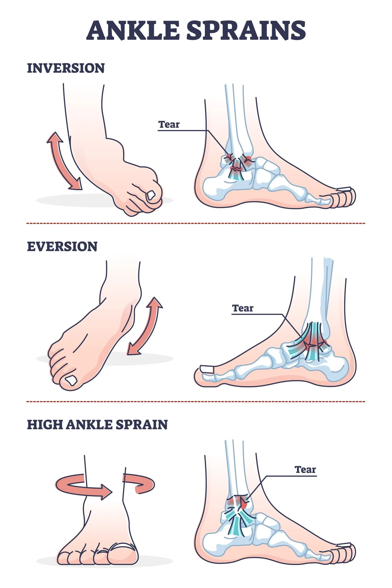 diagram illustrating the various types of ankle sprains and how they occur.