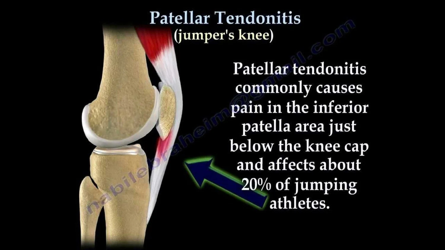Patellar tendonitis affects about 20% of jumping athletes.