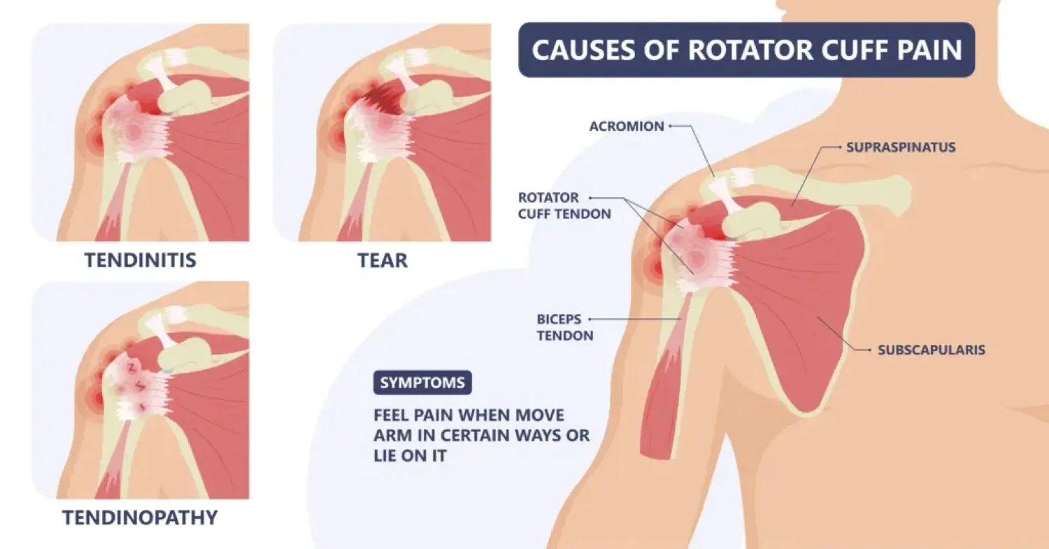 Infographic about the causes of rotator cuff pain. Including, rotator cuff tendinitis, rotator cuff tears, and rotator cuff tendinopathy