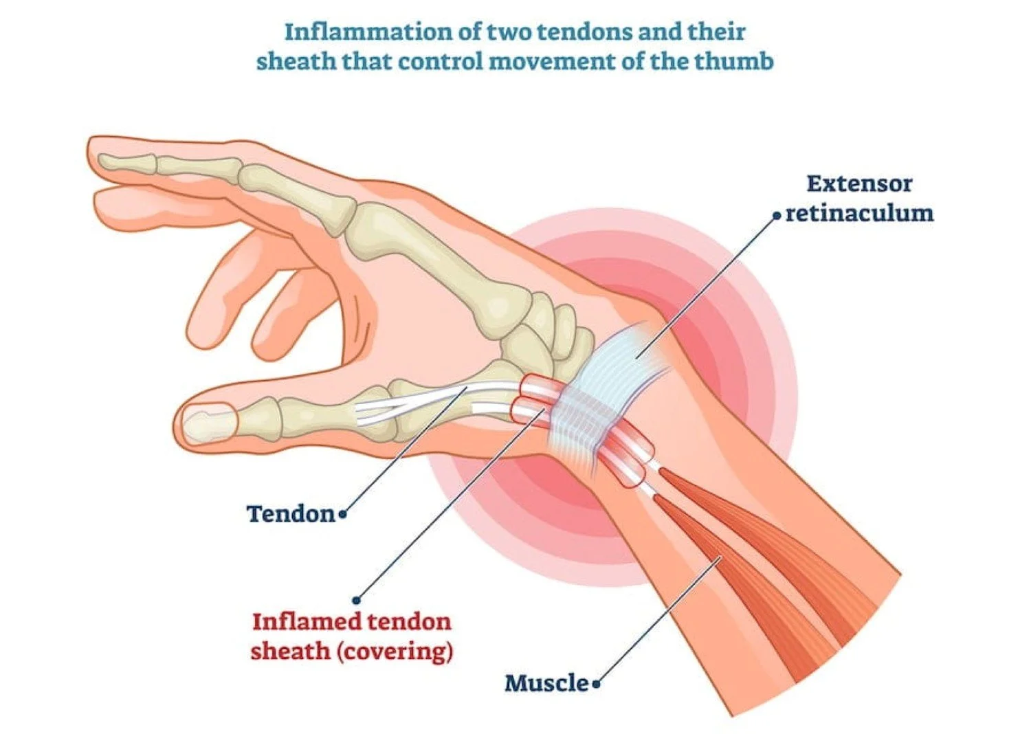 Infographic about De Quervain's Tenosynovitis, also known as mommy thumb. Thumb pain treatment Hillsboro, OR