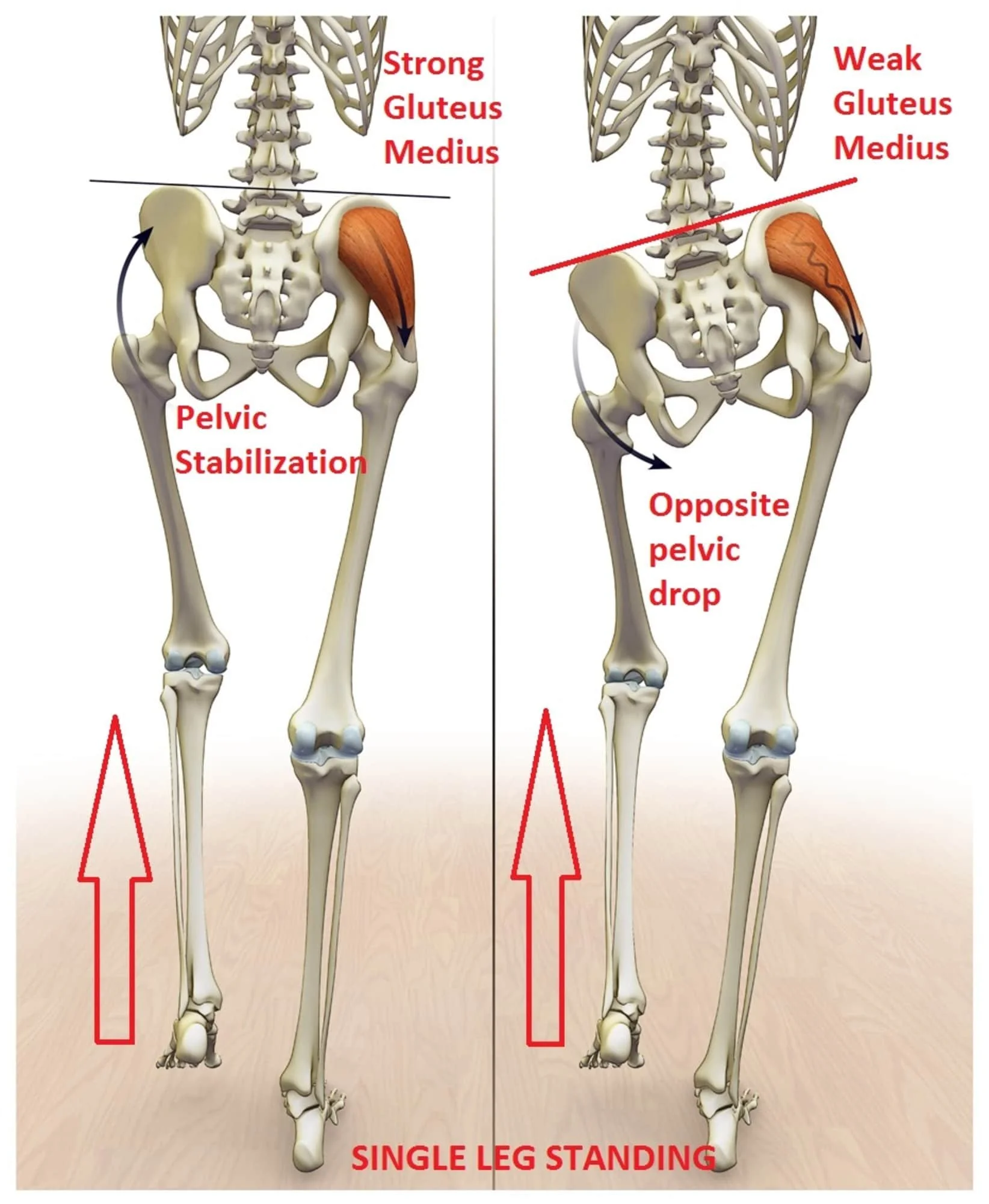 A diagram illustrating the Trendelenburg Sign, which comes from a weak gluteus medius and can cause hip pain