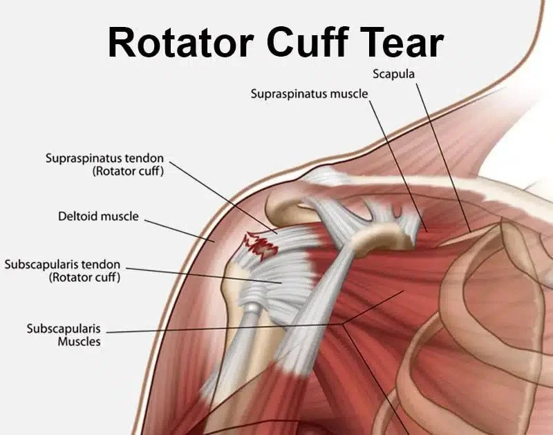 Rehabbing a rotator cuff injury: what you need to know.