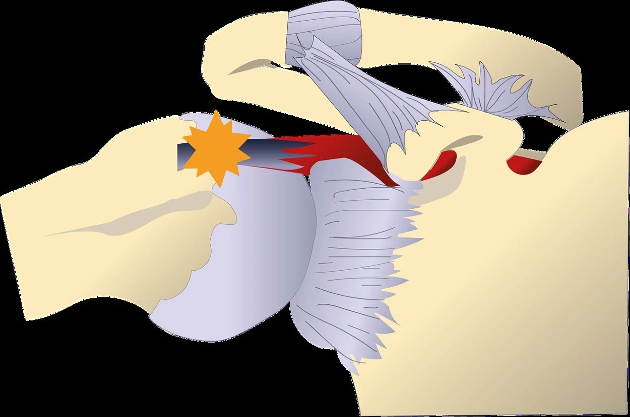 An image of the shoulder joint demonstrating supraspinatus tendinopathy caused by shoulder impingement.