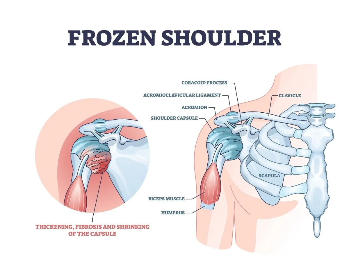 A diagram demonstrating the anatomy behind frozen shoulder (adhesive capsulitis)