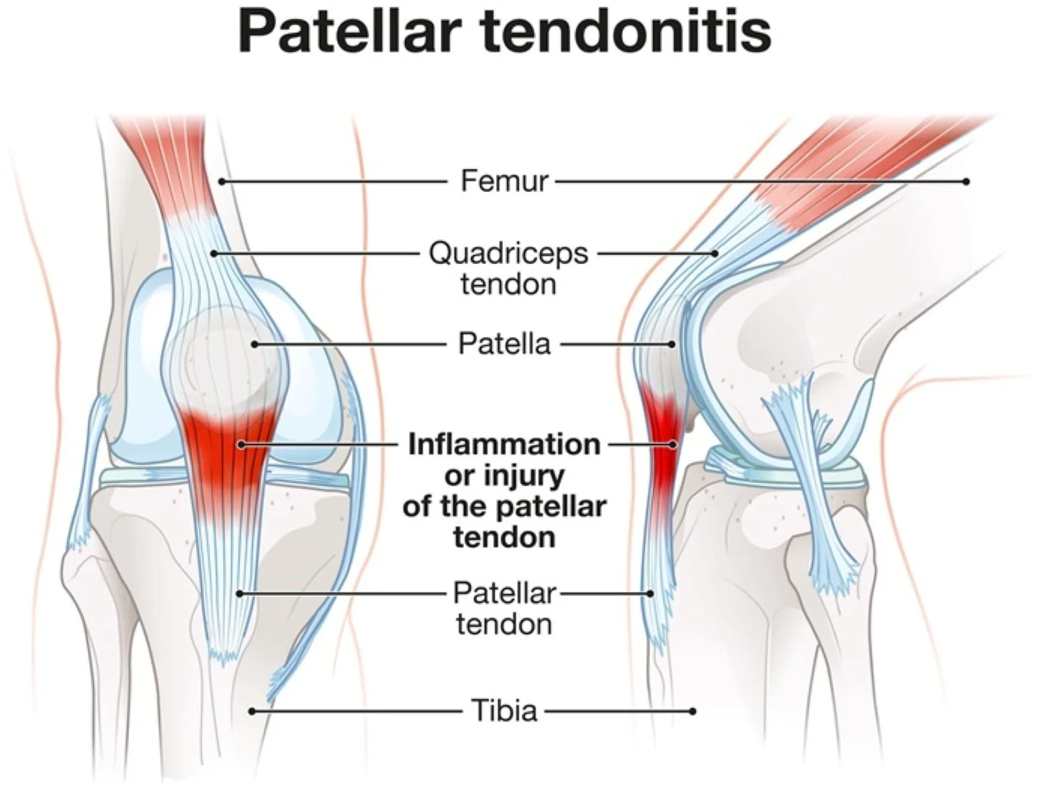 Patellar tendon pain treatment in Hillsboro, OR