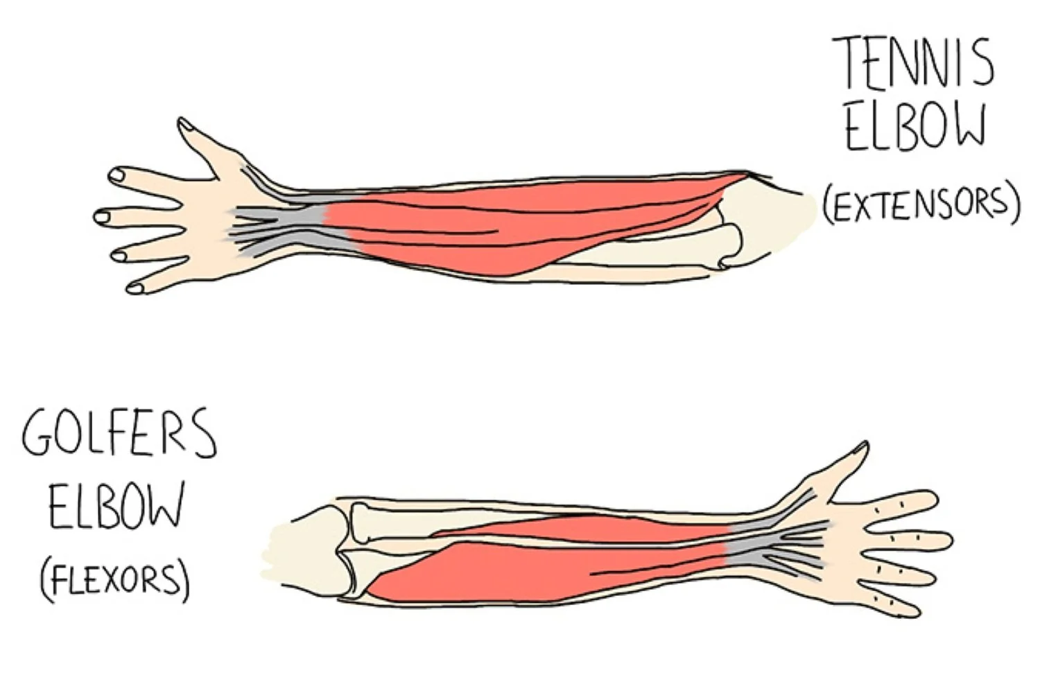 Drawing of the forearm anatomy involved in tennis elbow and golfer's elbow