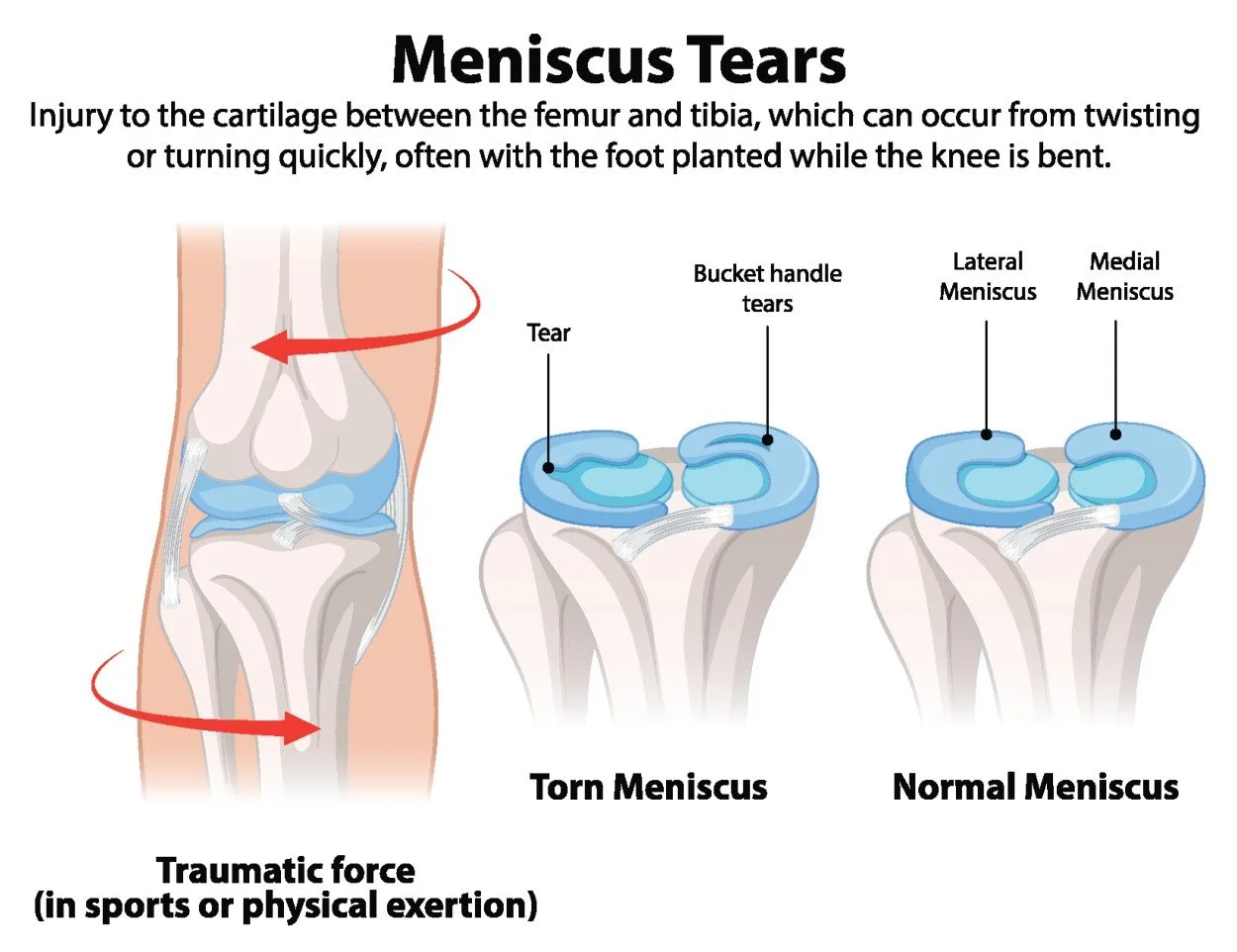 A diagram about meniscal tears including the knee anatomy and common causes.