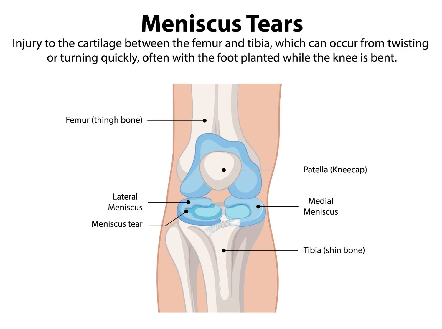 An infographic about the about the menisci and what a meniscus tear is.