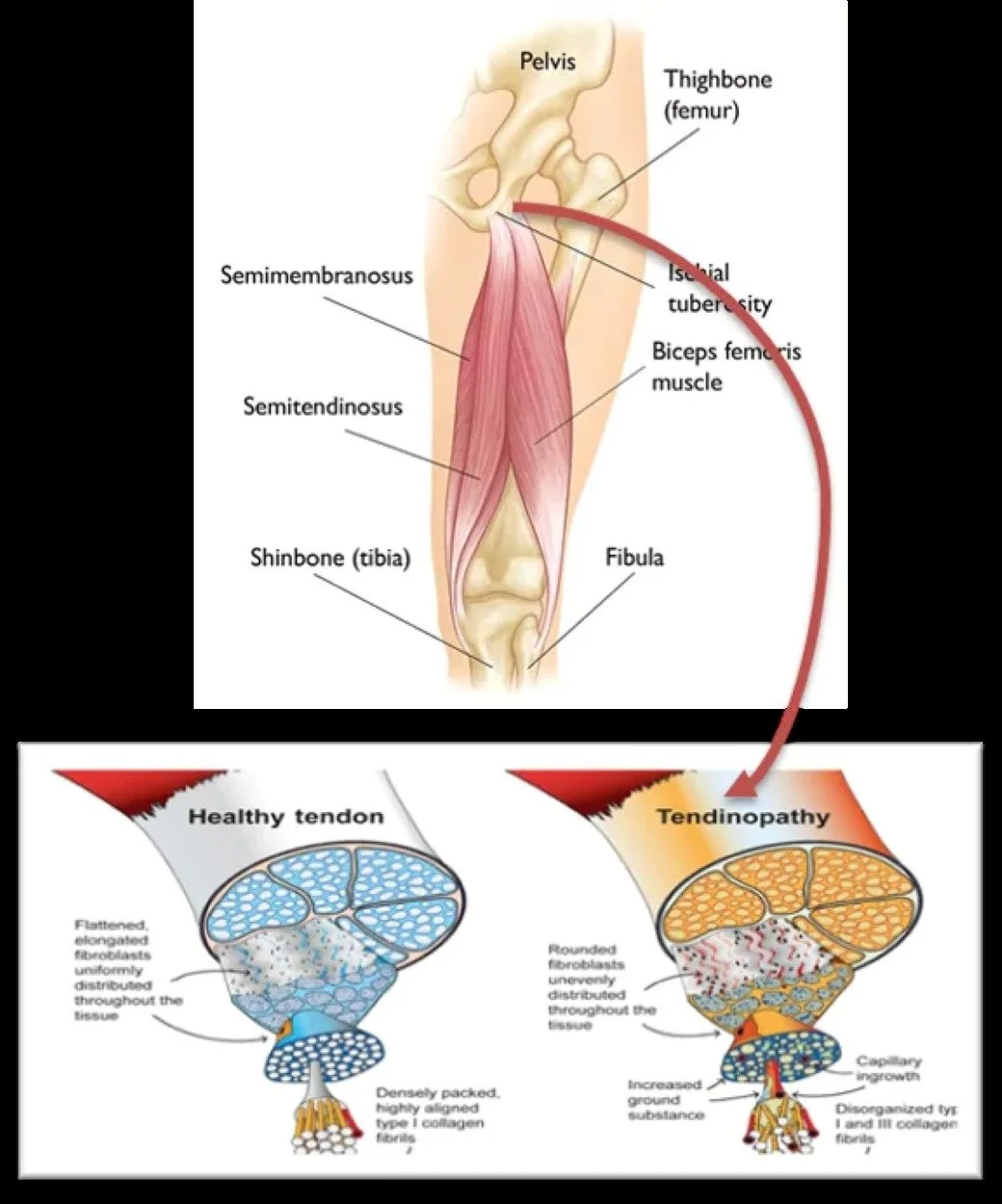 An infographic about the anatomy of proximal hamstring tendonitis or tendinopathy